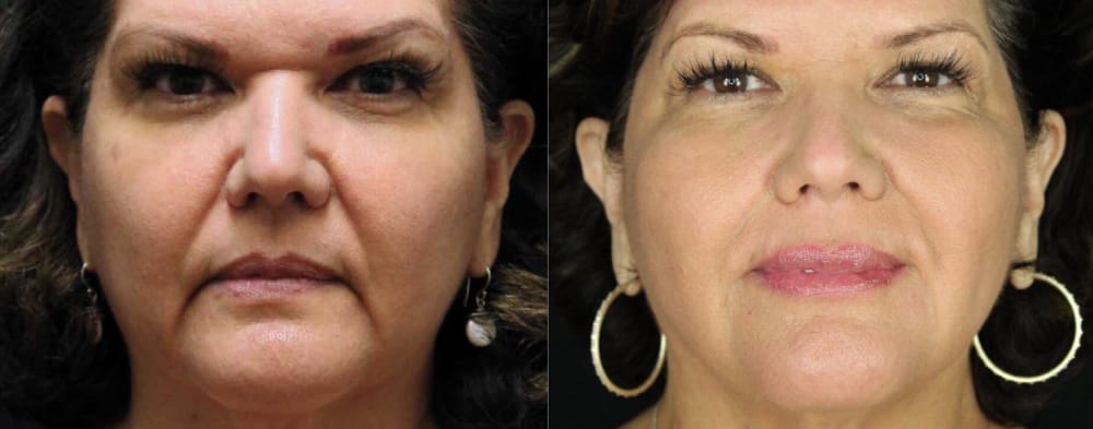 Before and after Sculptra