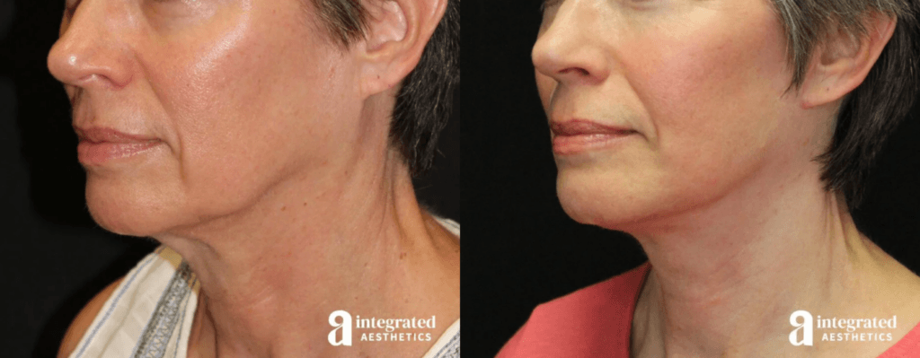 Female patient shown before and after facelift (lower face & neck lift) with lower blepharoplasty
