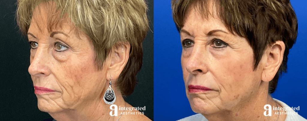 72-year-old patient shown before and after full-face Fractional CO2 Laser Resurfacing at Integrated Aesthetics