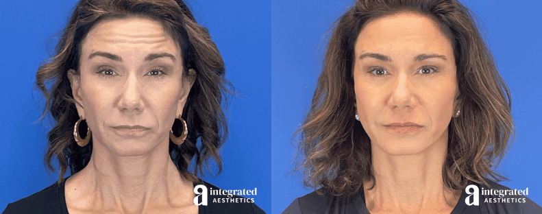50-year-old female Botox before-and-after for the forehead, masseters, and neck bands by Dr. Melissa Chiang in Spring, TX.
