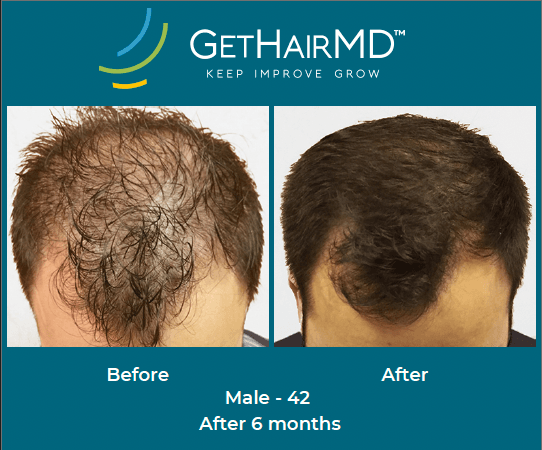 Side-by-side before and after photo of a male patient showing significant hair regrowth on the crown using the GetHairMD system at Integrated Aesthetics.