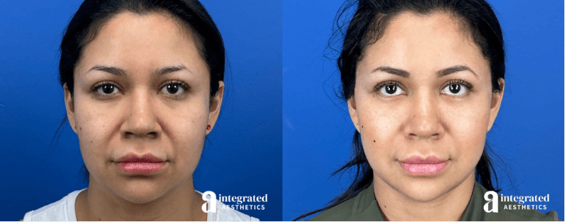 Deep Plane Facelift and Morpheus8 Before and After by Dr. Young Cho in Spring, TX
