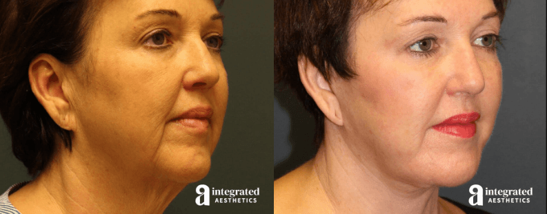 Before and after facelift results showing correction of filler fatigue in The Woodlands.