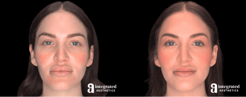 Lip reduction before and after results by Dr. Young Cho at Integrated Aesthetics in The Woodlands and Spring TX. Side-by-side comparison shows a 28-year-old female patient's journey from distorted lips caused by Bellafill injections to a defined, natural smile one month post-surgery.