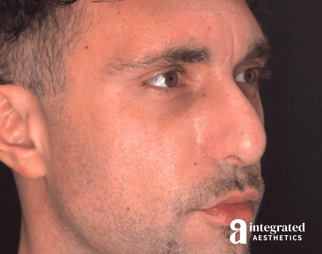 21565-rhinoplasty-after-angled-left-15