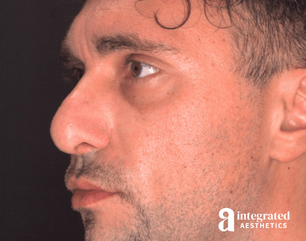 21565-rhinoplasty-after-angled-right-13