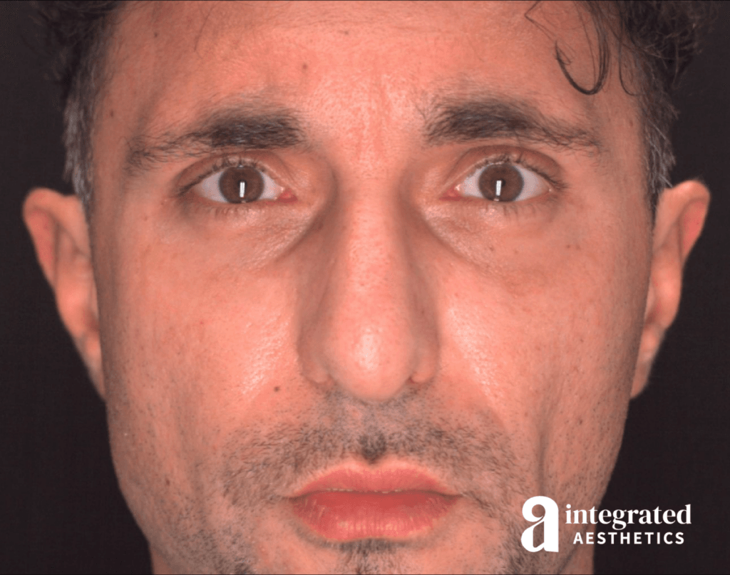Rhinoplasty