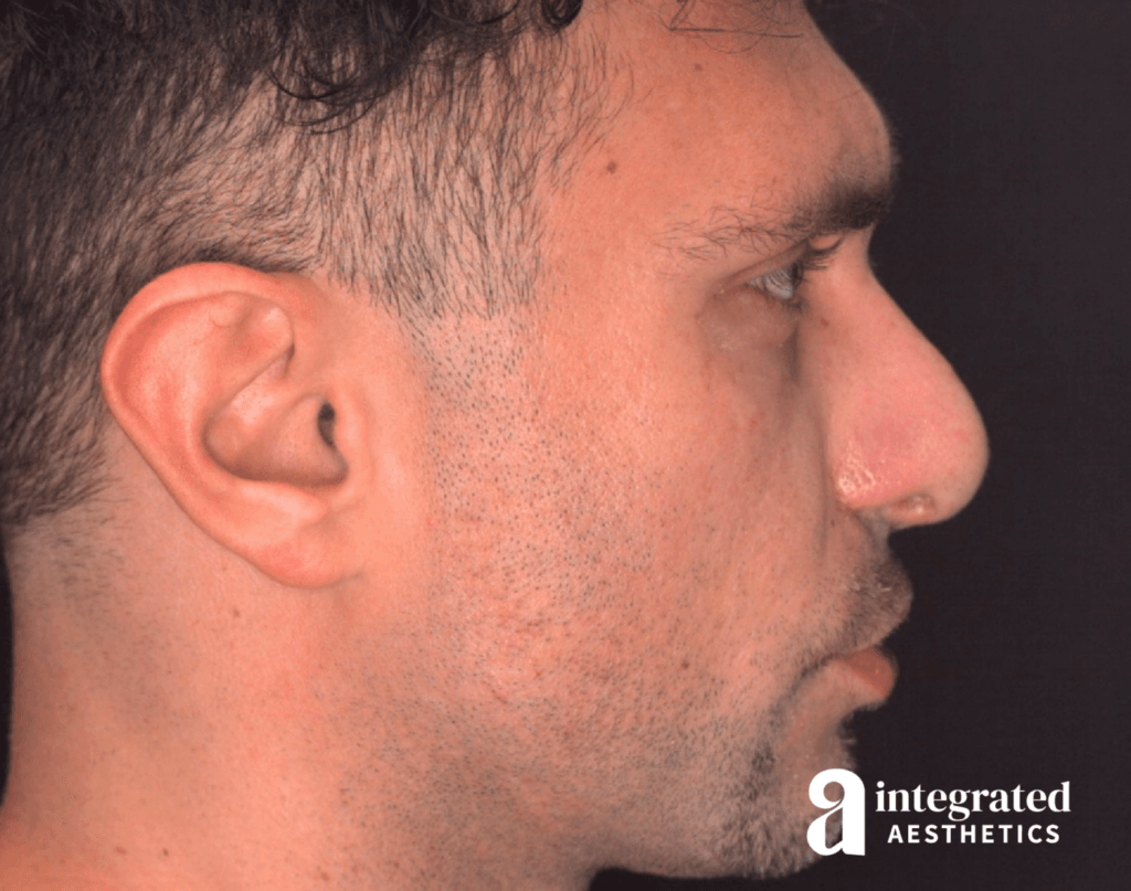 21565-rhinoplasty-after-left-19