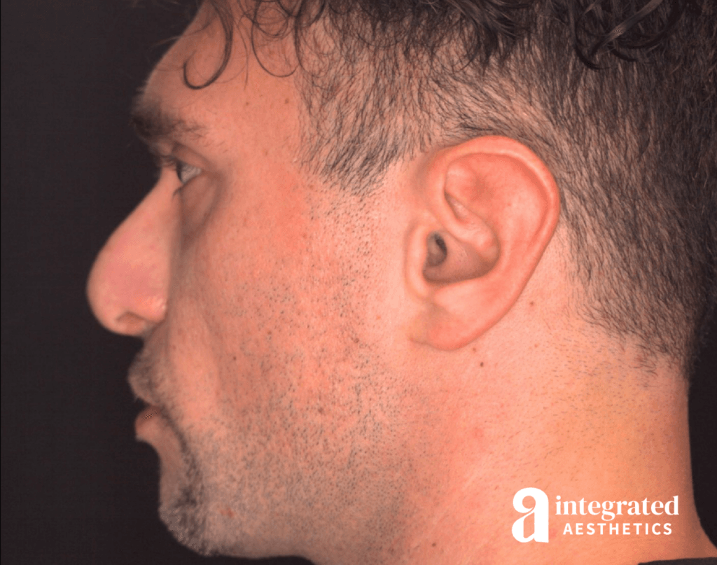 21565-rhinoplasty-after-right-17