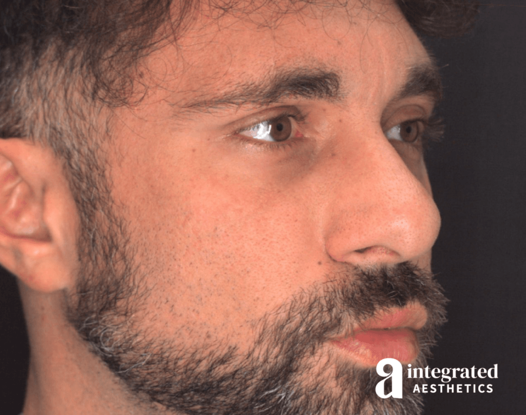 21565-rhinoplasty-before-angled-left-14
