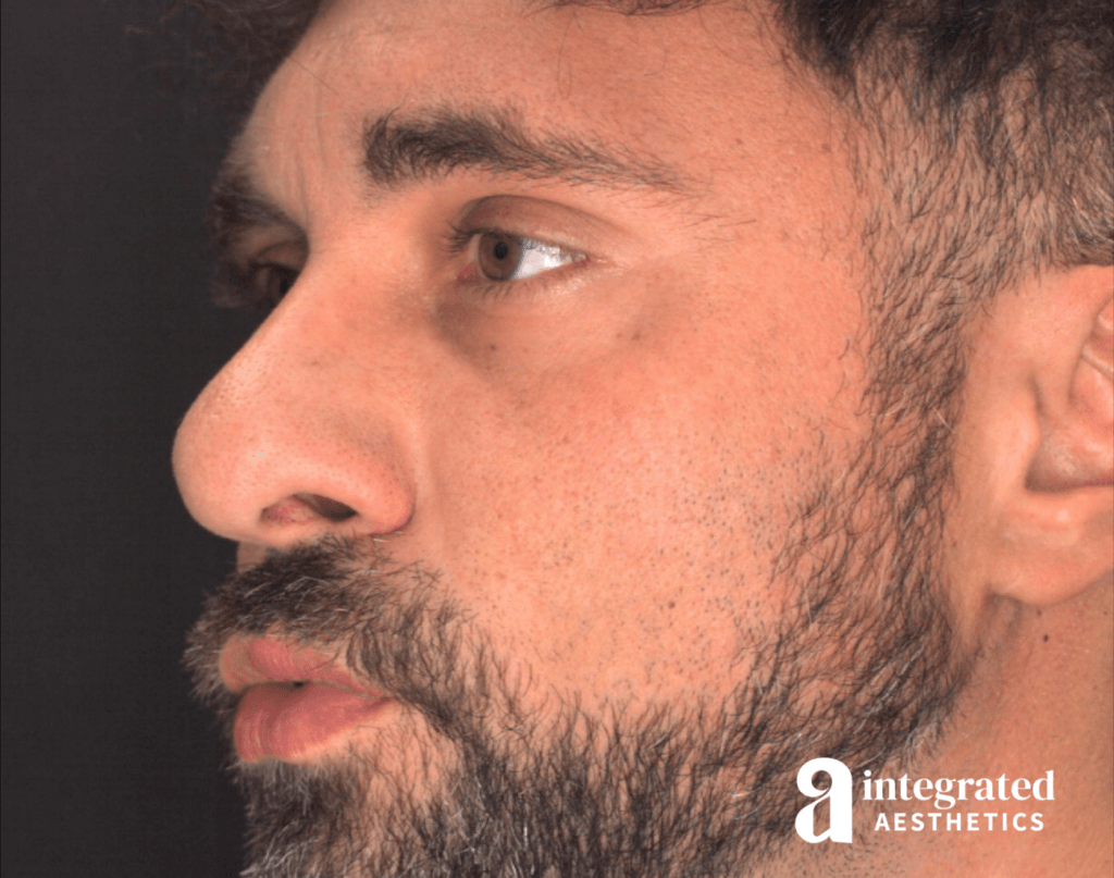 21565-rhinoplasty-before-angled-right-12