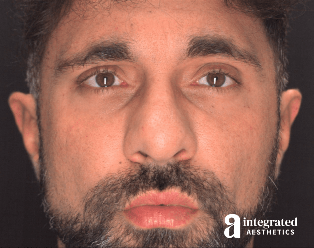 Rhinoplasty