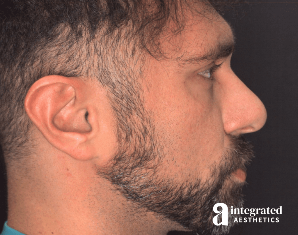 21565-rhinoplasty-before-left-18