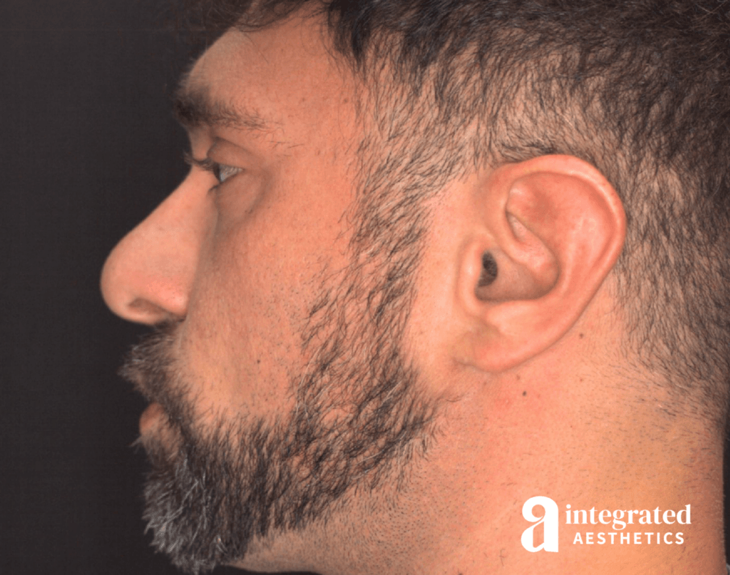 21565-rhinoplasty-before-right-16