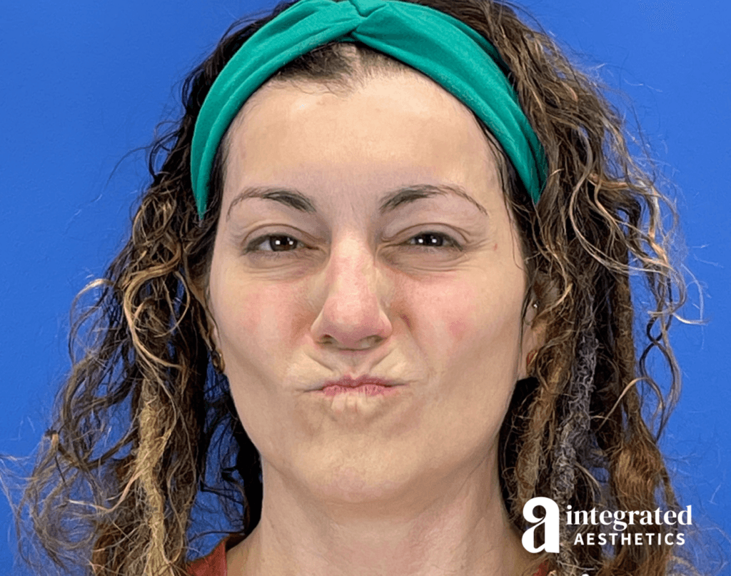 Botox