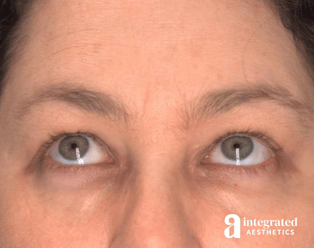 29080-accutite-before-eyesup-12