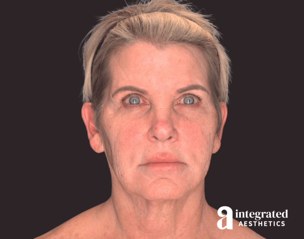 Facelift