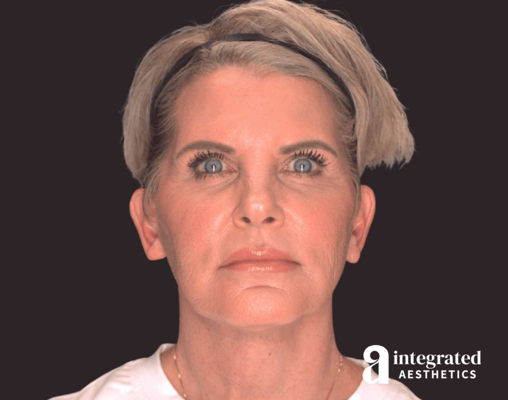 Facelift