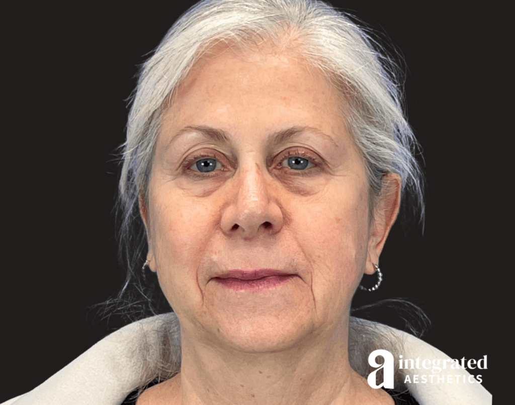 Front view of a 66-year-old female patient before dermal filler treatment, showing visible volume loss in the midface and cheeks, alongside a loss of definition in the chin and lower face.