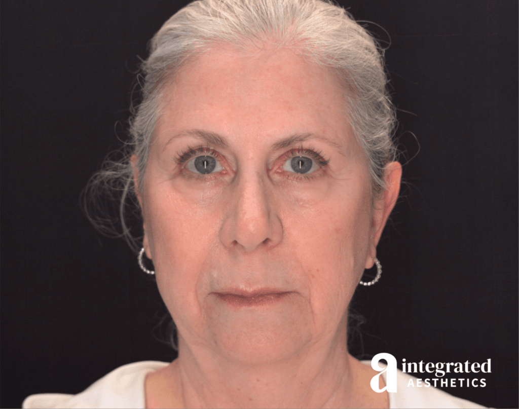 Front view of a 66-year-old female patient 2 months after MD Codes dermal filler treatment by Dr. Cho, displaying restored volume in the cheeks and a youthfully contoured chin.