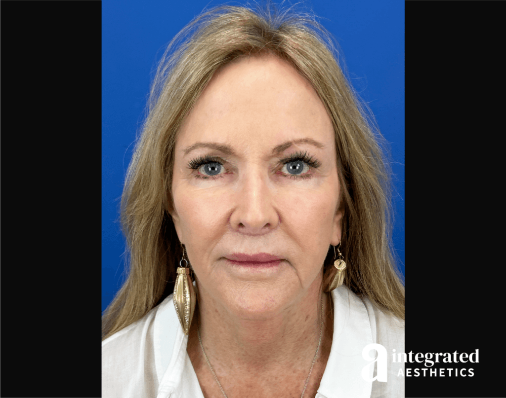 Facelift
