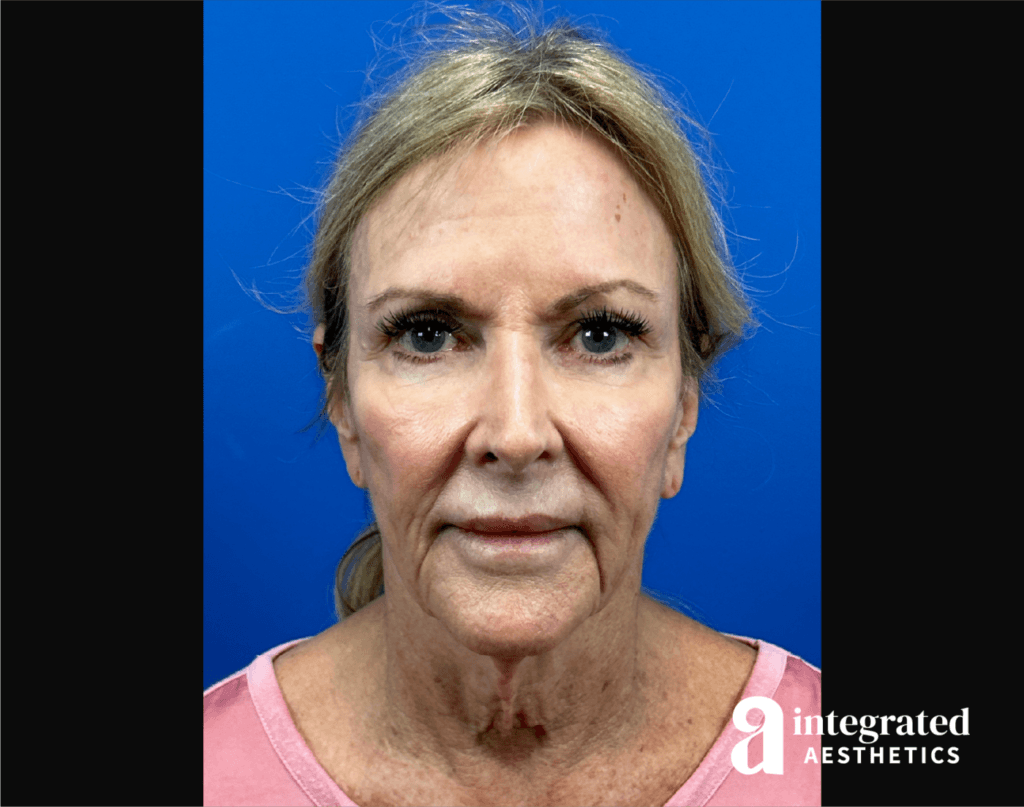 Facelift
