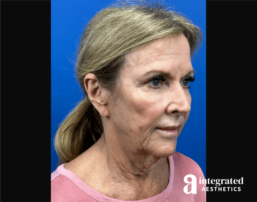 deep-plane-facelift-brow-lift-before-left-angled-the-woodlands