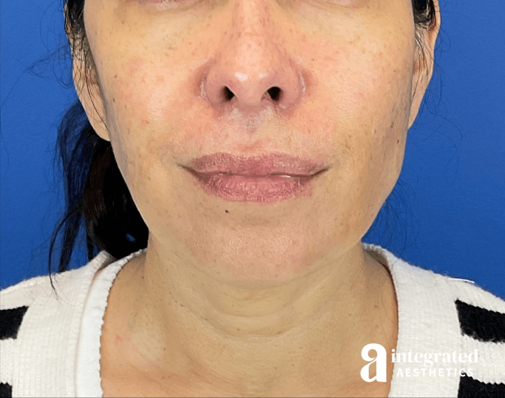Sofwave and Chemical Peel
