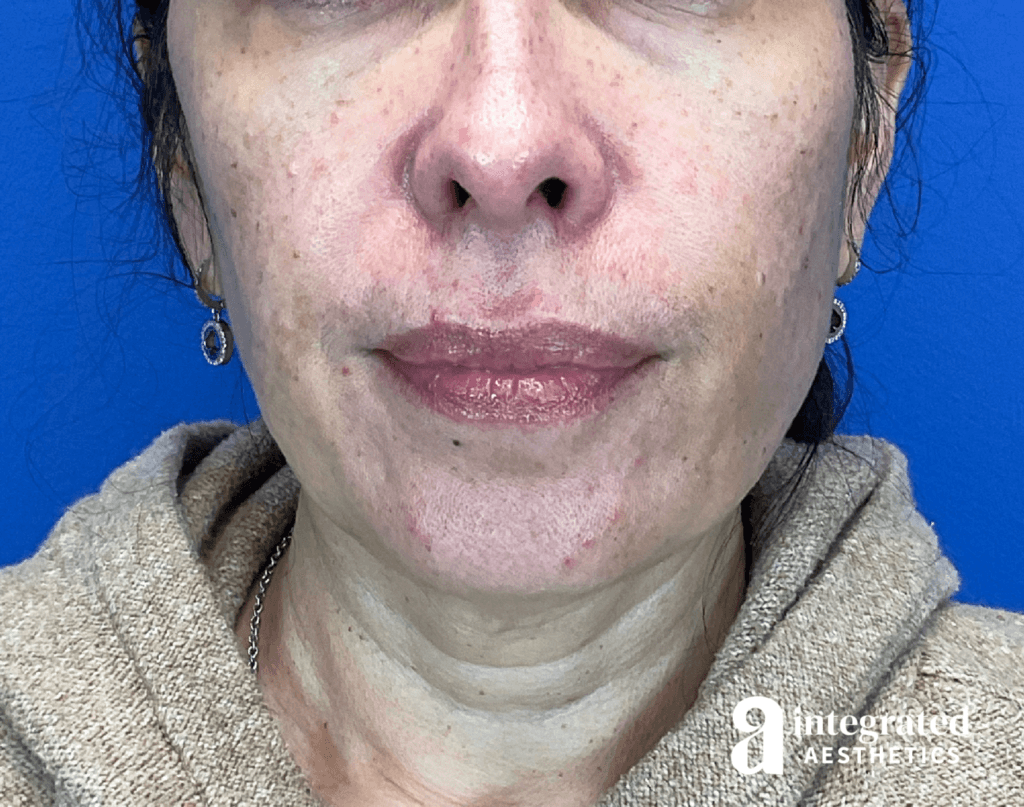 Sofwave and Chemical Peel