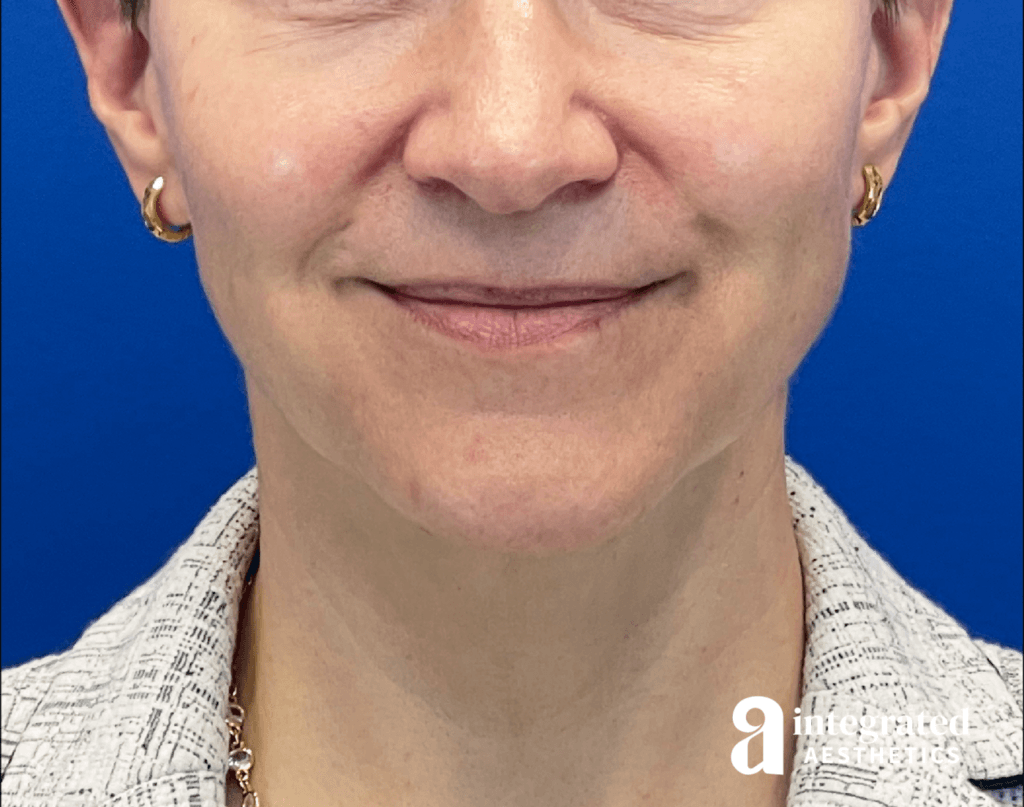 Front view of a 53-year-old female patient before 3 year non-surgical facial rejuvenation treatment plan with Dr. Melissa Chiang in The Woodlands, TX.