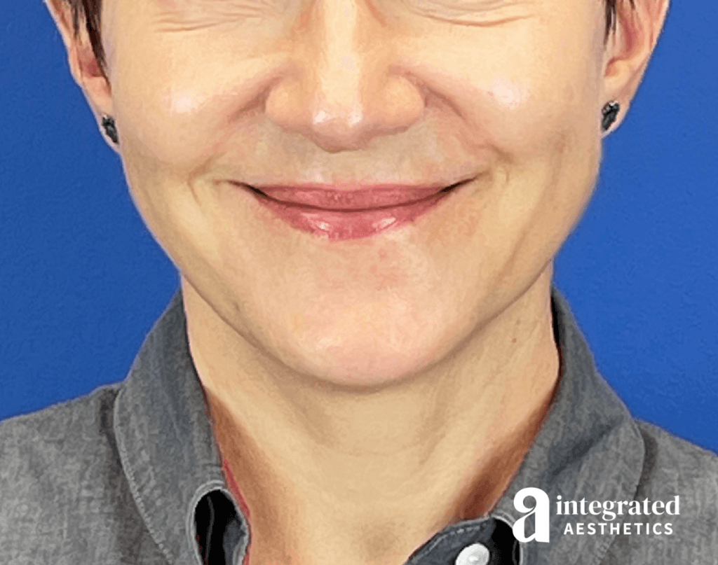 Front view of a 53-year-old female patient after 3 year non-surgical facial rejuvenation treatment plan with Dr. Melissa Chiang in The Woodlands, TX.