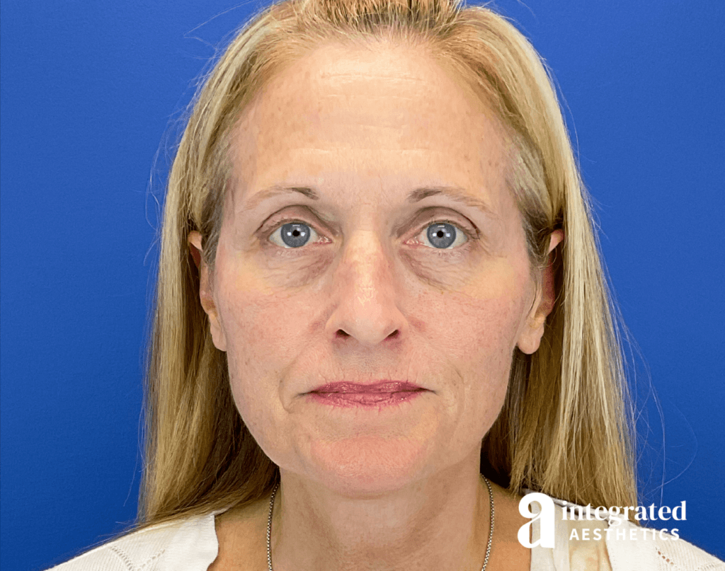 Botox, Forma, Microneedling, and Chemical Peel