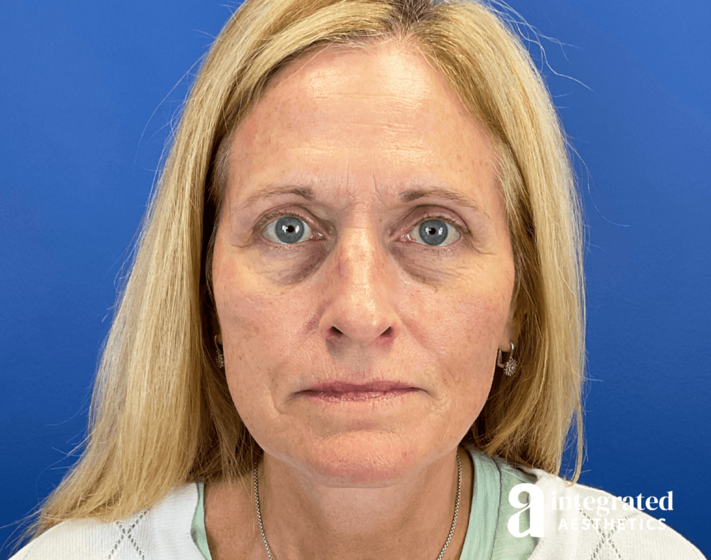 Botox, Forma, Microneedling, and Chemical Peel