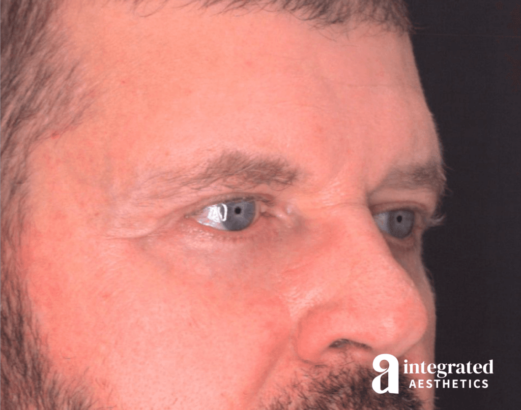 28998-blepharoplasty-after-angled-left-15