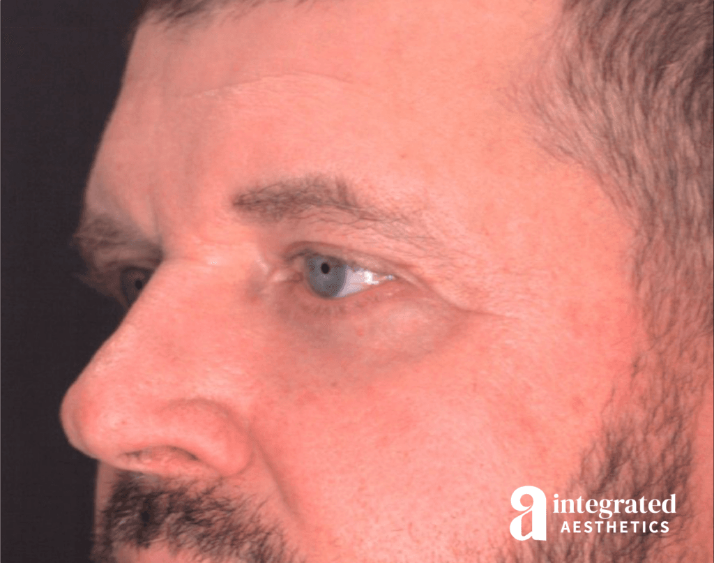 28998-blepharoplasty-after-angled-right-13