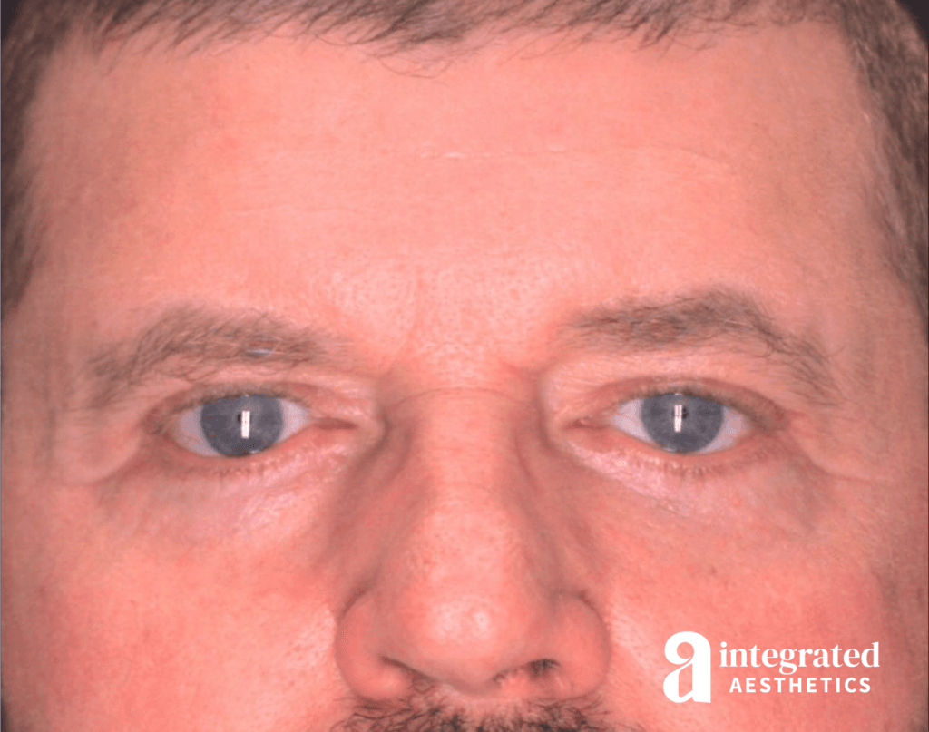 Blepharoplasty