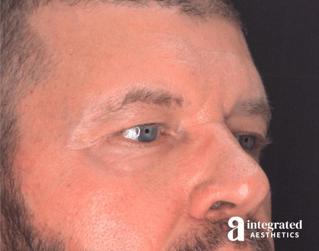28998-blepharoplasty-before-angled-left-14