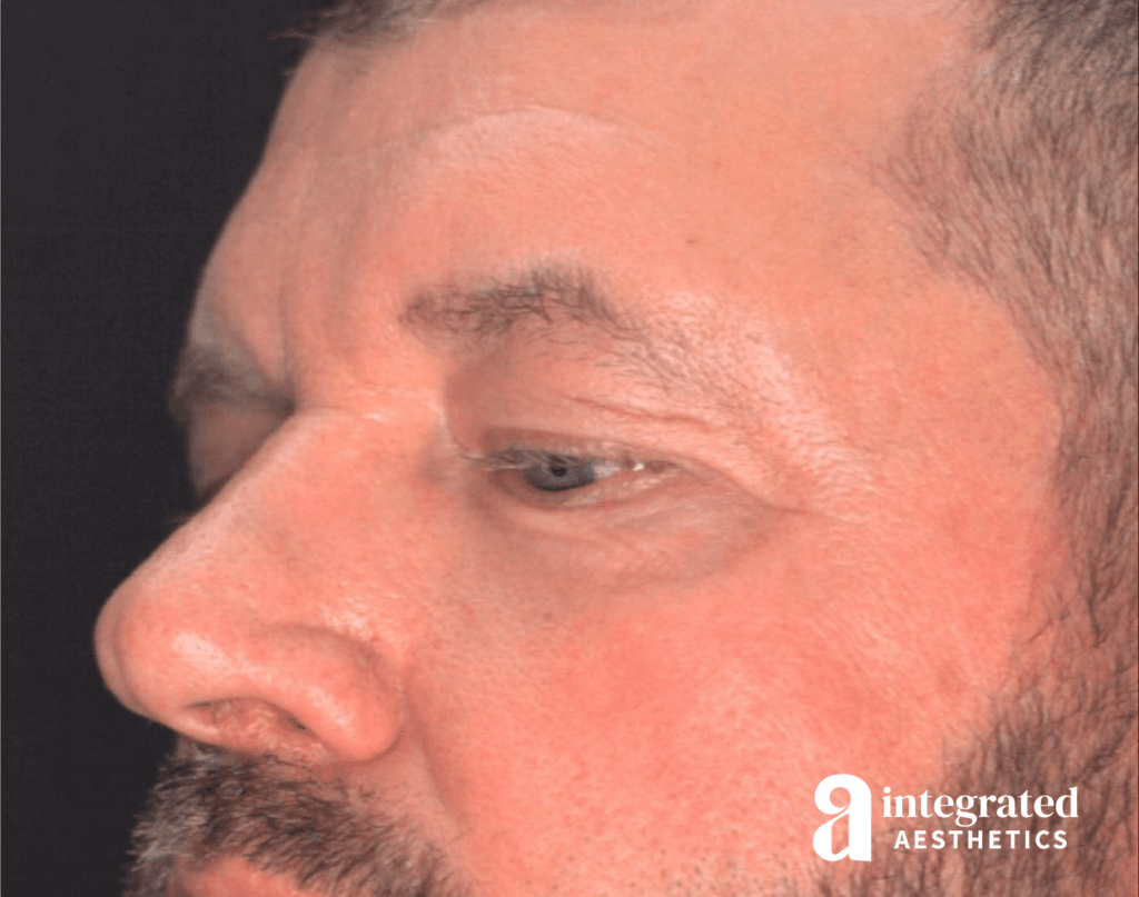 28998-blepharoplasty-before-angled-right-12