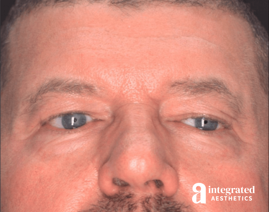 Blepharoplasty