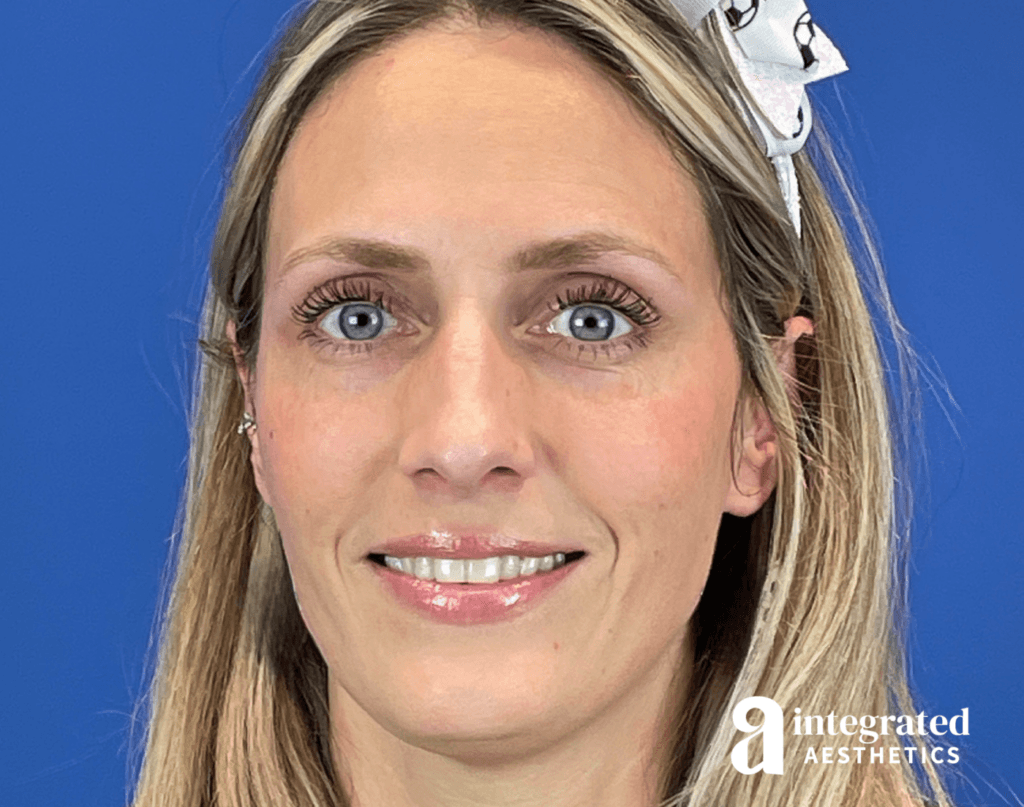 37-year-old female after Botox and filler treatment to resolve smile asymmetry.