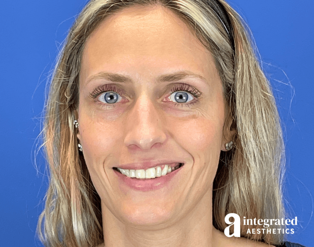 37-year-old female before Botox and filler treatment to resolve smile asymmetry.