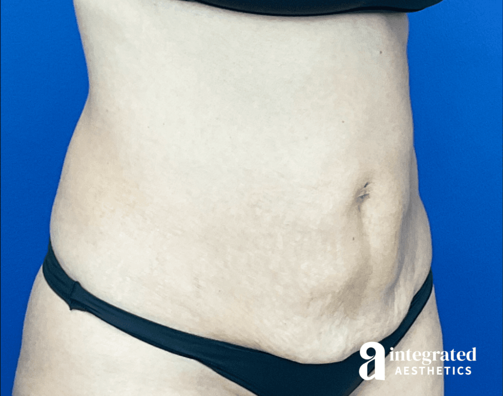 01070-Coolsculpting-Morpheus8-after-angled-left-15