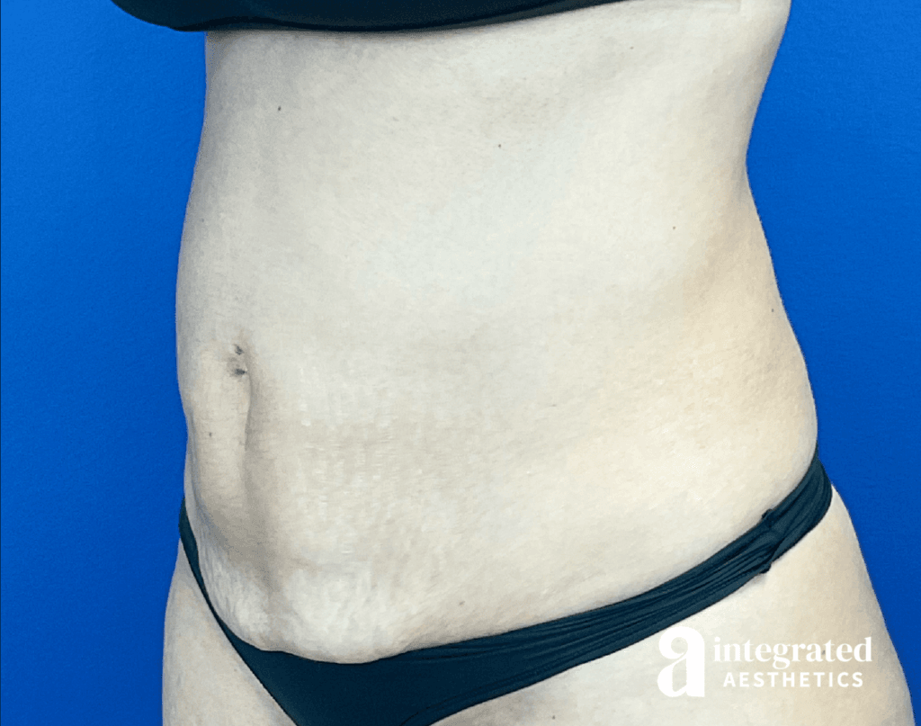 01070-Coolsculpting-Morpheus8-after-angled-right-13