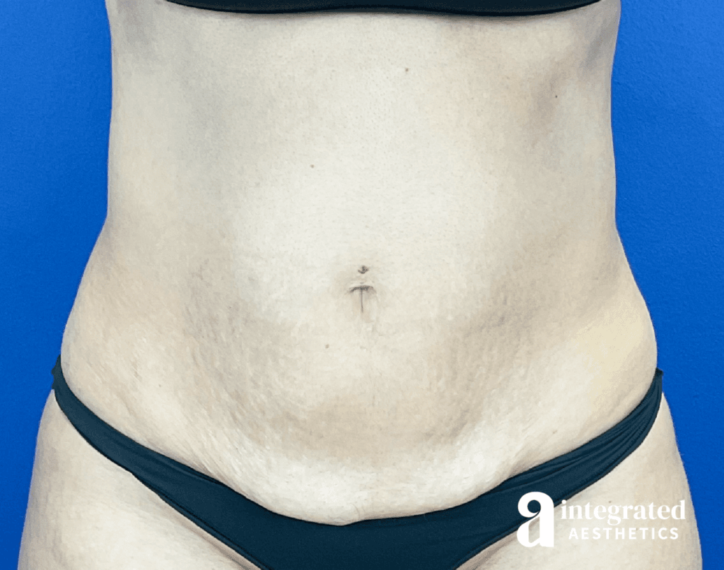 CoolSculpting, Morpheus8 (Body), and Emsculpt Neo