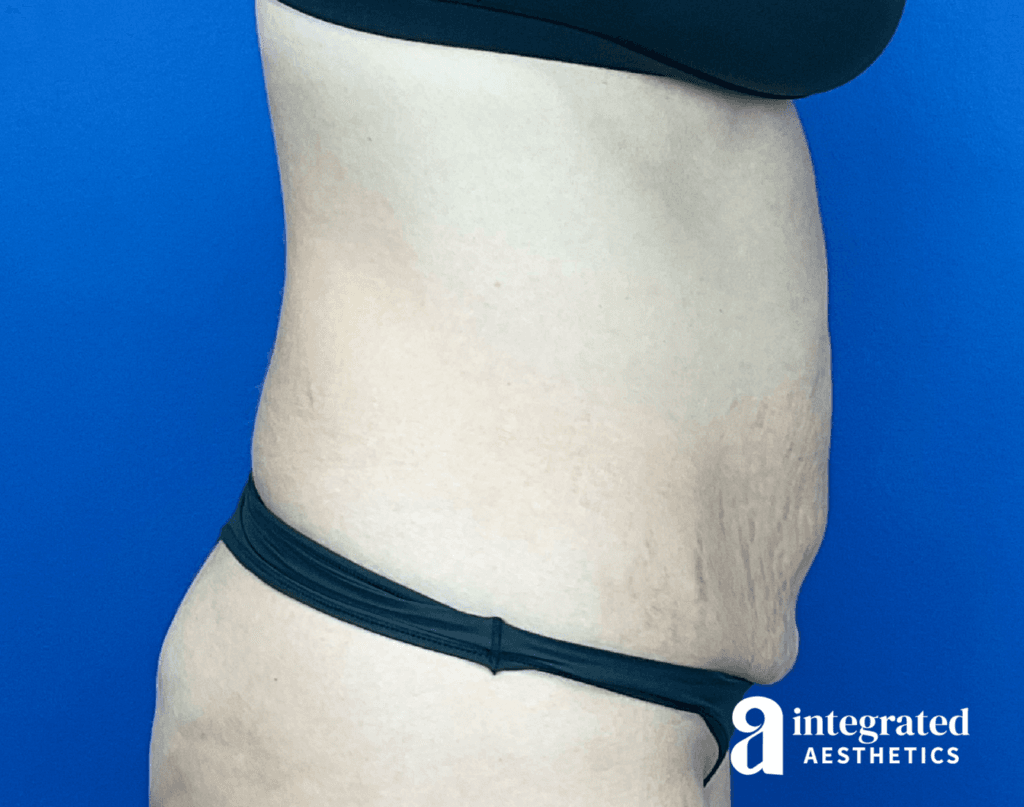 01070-Coolsculpting-Morpheus8-after-left-21