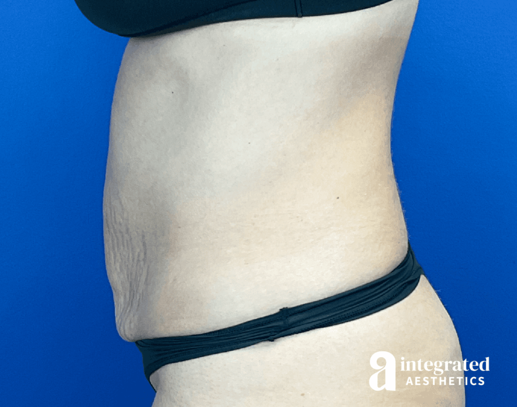 01070-Coolsculpting-Morpheus8-after-right-17
