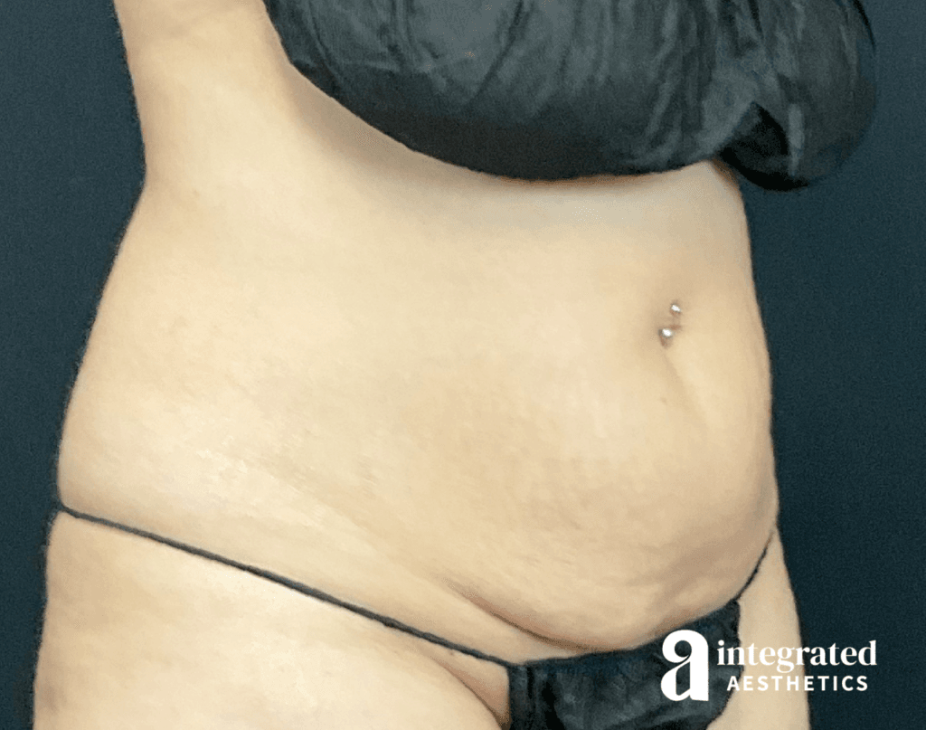 01070-Coolsculpting-Morpheus8-before-angled-left-14