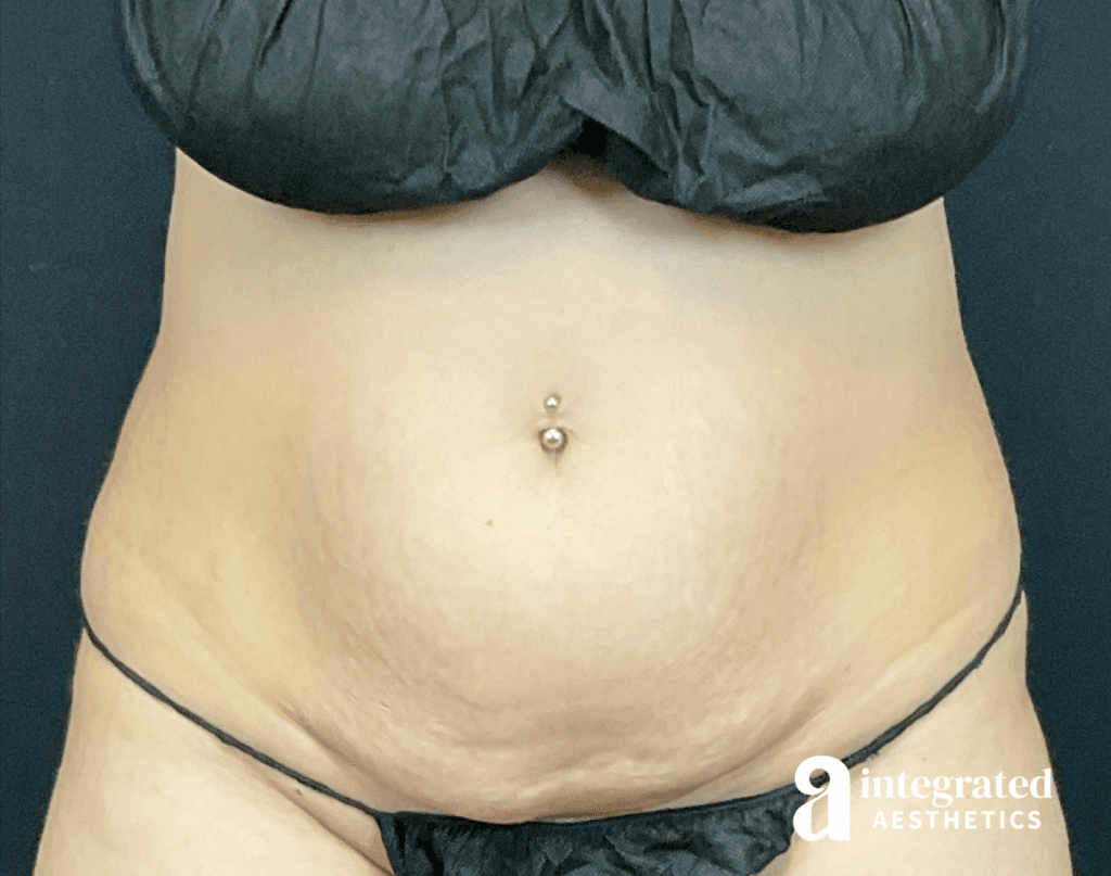 CoolSculpting, Morpheus8 (Body), and Emsculpt Neo