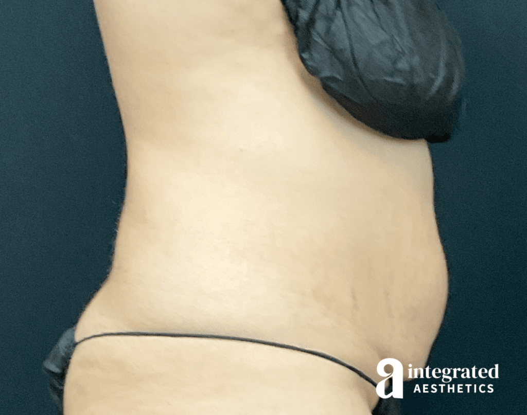 01070-Coolsculpting-Morpheus8-before-left-20