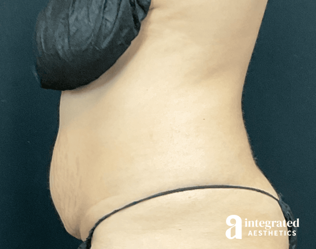 01070-Coolsculpting-Morpheus8-before-right-16